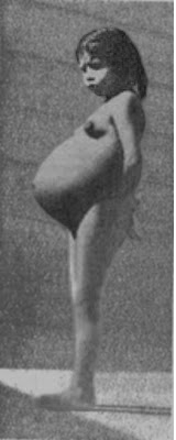 Lina Medina, world's youngest mum, some believed it was a hoax, but itt is backed up by lots of medical evidence, so sorry folks, we can't comfort ourselves with that one.