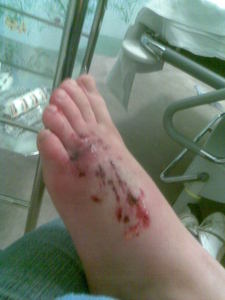  Georgia's Foot Shortly After The Incedent, At The Hospital