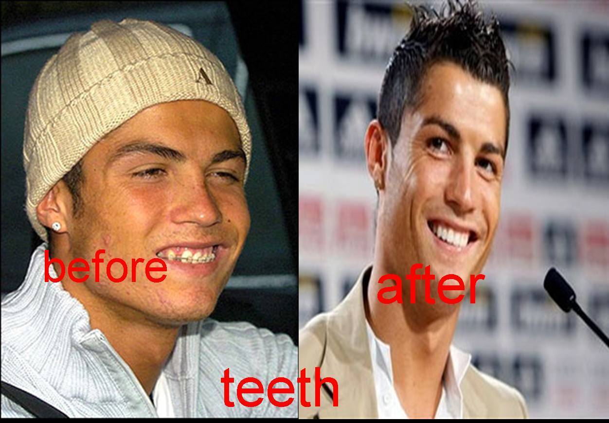Cristiano Ronaldo teeth before and after - Cristiano Ronaldo Fan Art ...