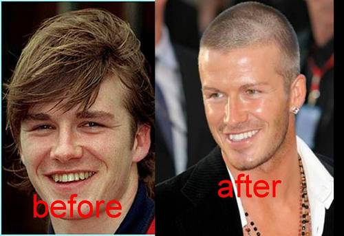  David Beckham teeth before and after