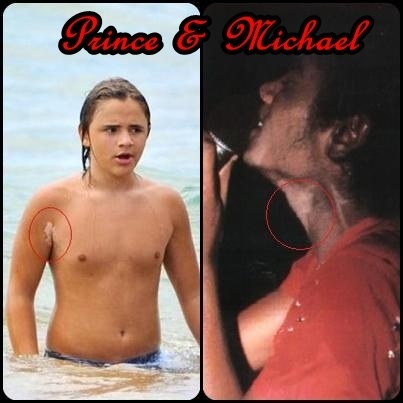  Prince and Michael vitiligo