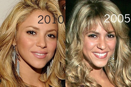  Shakira plastic surgery 2