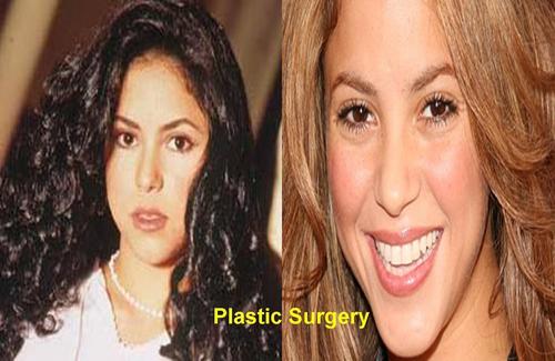  Shakira plastic surgery